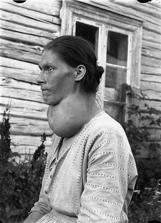 goitre, la consommation des Brassicacées est contre indiquée en cas de problème de thyroïde.